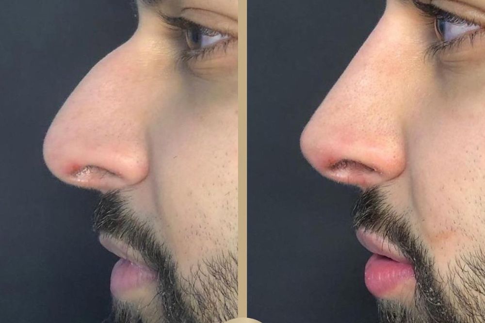 The Real Price of a Nose Job